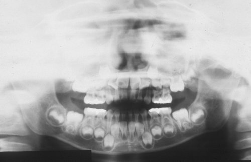 混合歯列期（小学生時期）の口腔